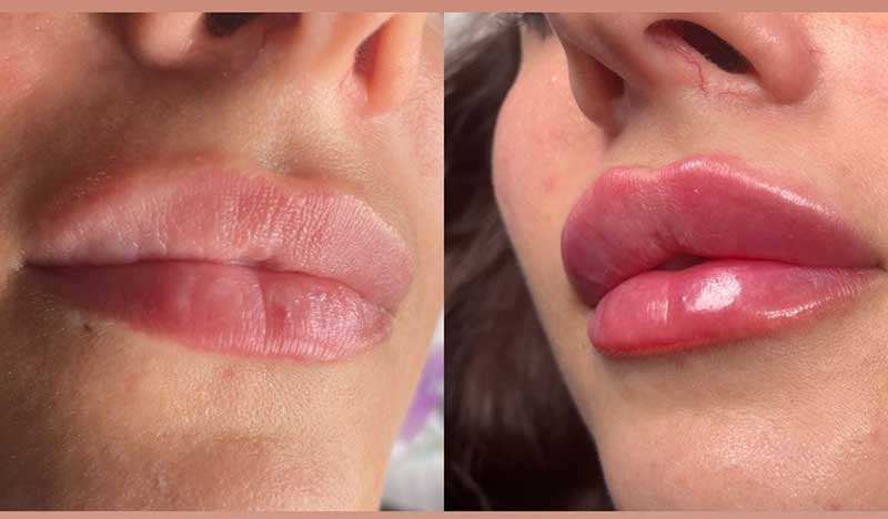 Labios Rusos: La Técnica de Aumento de Labios que está Revolucionando la Estética