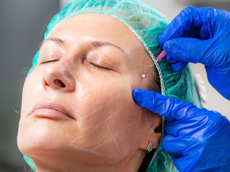 Mesoterapia facial en San Andreu de la Barca: Revitaliza y nutre tu piel de manera profunda y duradera